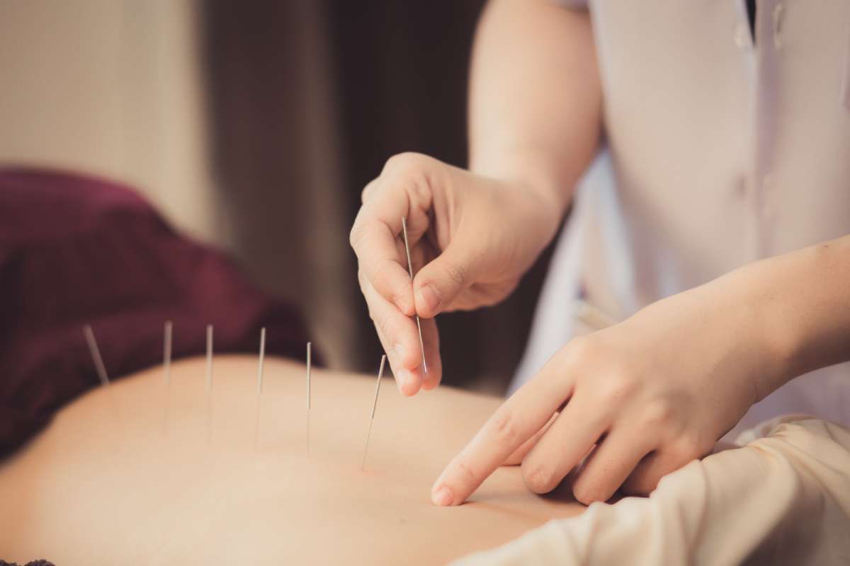 A person getting acupuncture on their back.